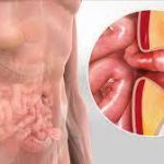 inguinal hernia symptoms