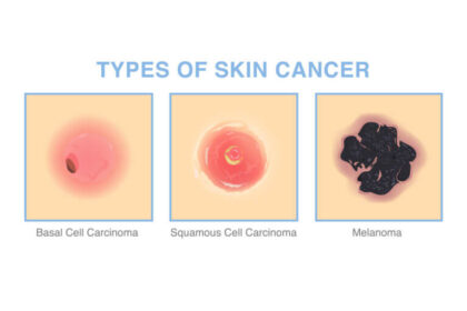 Skin cancers